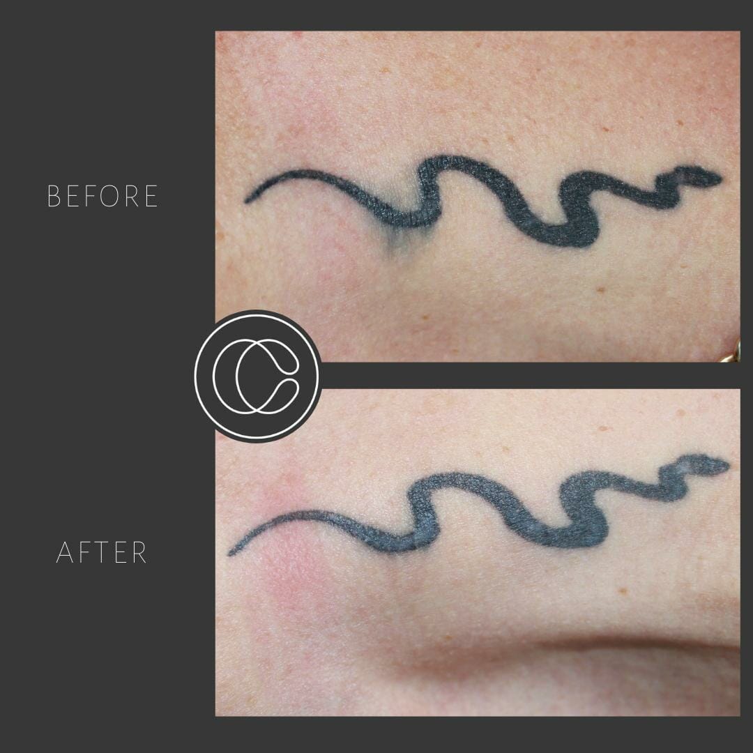 Tattoo Blowout Causes And Preventions Psycho Tats